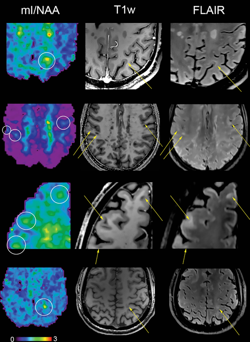 New MRI Technique Detects MS Brain Changes Earlier