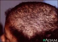 Bald Patches