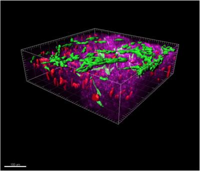 Spread of Pancreatic Cancer Cells (3-D)