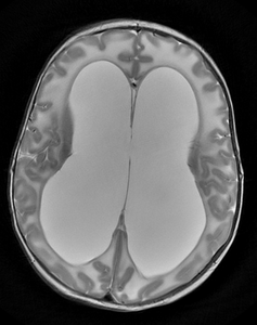 Severe hydrocephalus