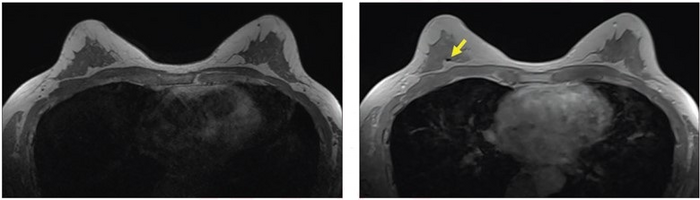 57-year-old patient with breast biopsy clips who underwent breast MRI for high-risk screening