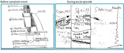 Dysgraphia in PANDAS