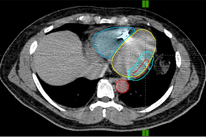 Noninvasive Ablation