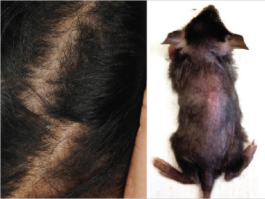 Comparative Hair Loss Due to WNT10A Mutations