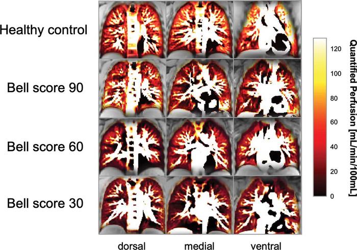 Dorsal, medial, and ventral phase-resolved functional lung MRI perfusion maps show distinct perfusion phenotypes related to the severity of chronic fatigue assessed with the Bell score in three participants with post–COVID-19 and in a healthy control.