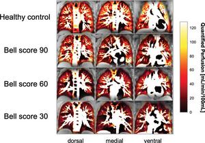 Dorsal, medial, and ventral phase-resolved functional lung MRI perfusion maps show distinct perfusion phenotypes related to the severity of chronic fatigue assessed with the Bell score in three participants with post–COVID-19 and in a healthy control.