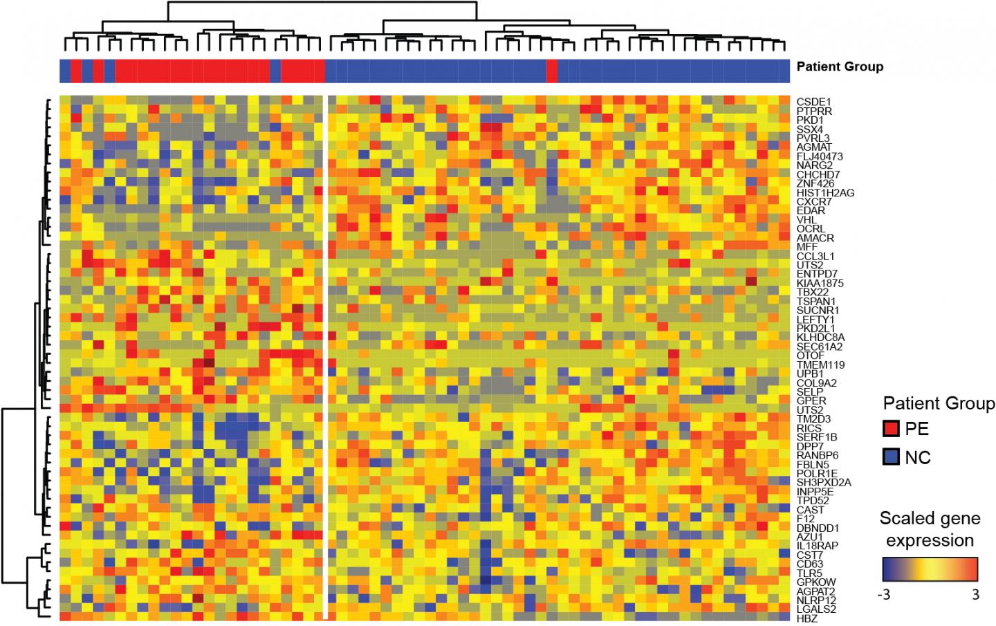 An RNA Signature Predicts Preeclampsia In Pregnant Lupus Patients