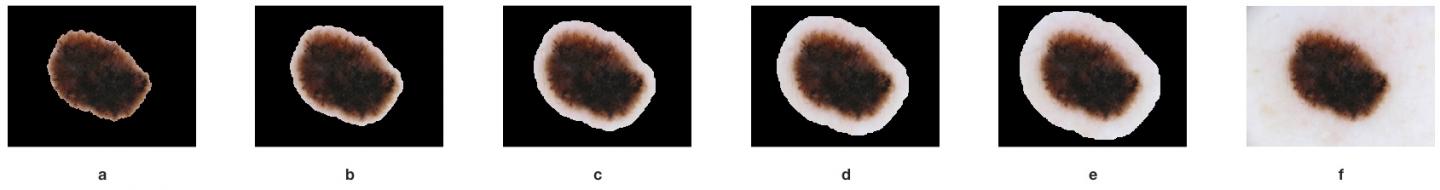 This 'Sweet Spot' Could Improve Melanoma Diagnosis (1 of 2)