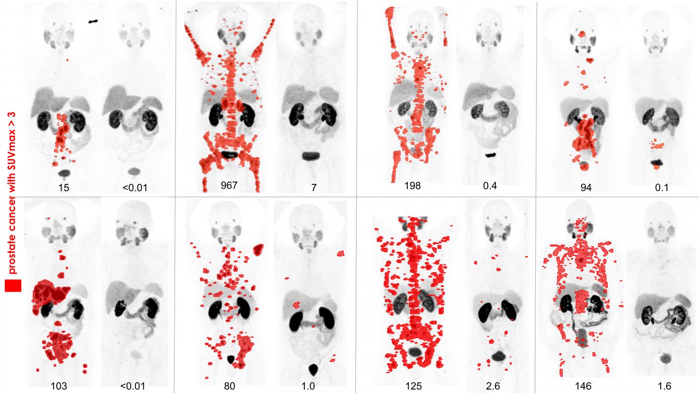 PSMA PET before and after lutetium-177 PSMA617 theranostics in 8 patients with metastatic prostate cancer