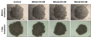 Drug prevents human breast cancer recurrence and metastasis