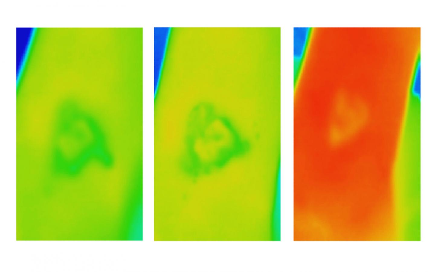 Thermal Imaging for VLU (Unhealed)