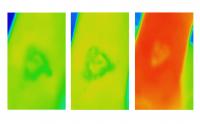 Thermal Imaging for VLU (Unhealed)