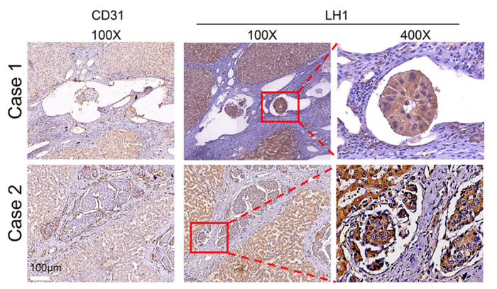 HCC tumour embolus