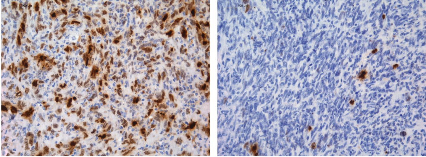 Temozolomide Gliomas, CNIO