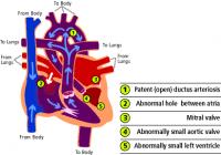 Diagram of Hypoplastic Left Heart Syndrome