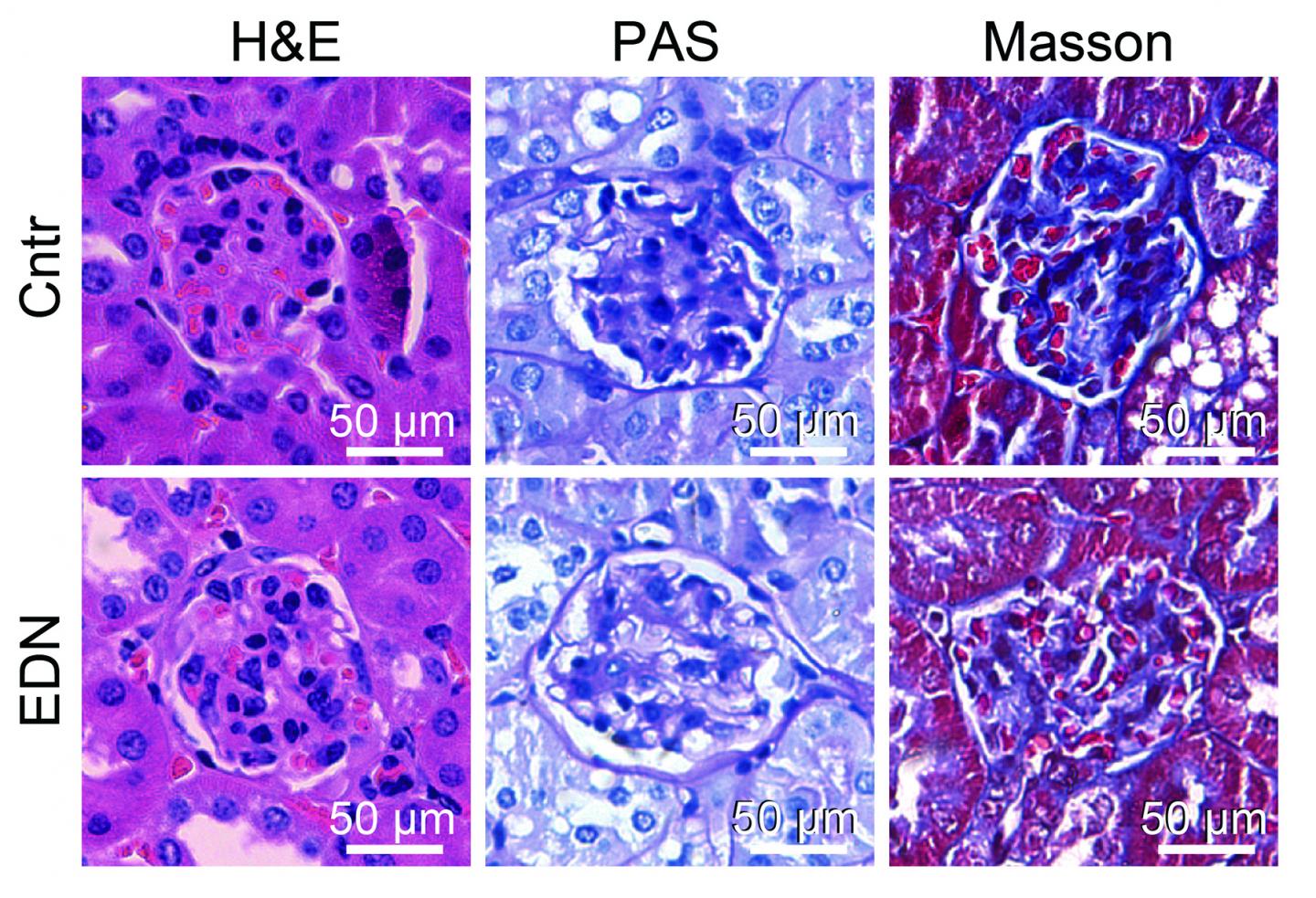 Finding a Balance in Treating Diabetic Kidney | EurekAlert!
