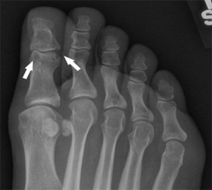 Patient foot with gout