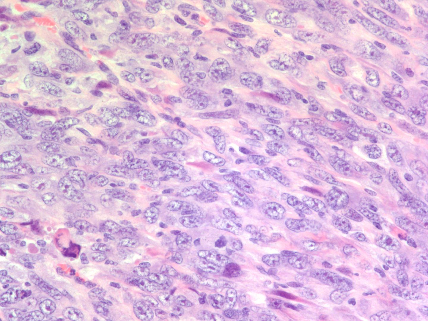 Mesothelioma, CNIO