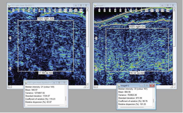 High-Resolution Dermal Ultrasound scan
