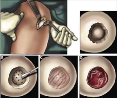 Cartilage Repair Surgery