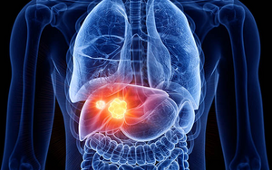 liver cancer graphic