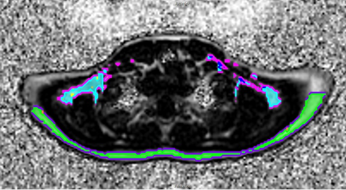 MRI image of brown fat