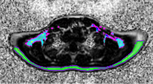 MRI image of brown fat