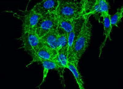 Researchers Discover a Potential New Target for Cancer Treatment