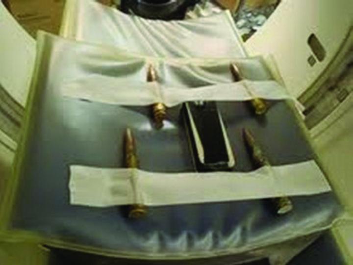 Examples of Projectiles that May Be Removed during Surgery