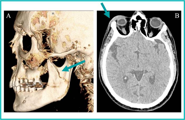 Left mandibular fracture in a 35-year-old transgender woman