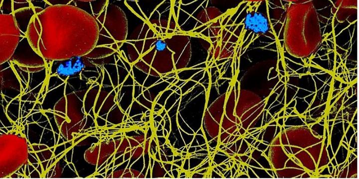 Blood Clot Seen through An Electron Microscope