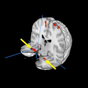 Heightened Responses in the Brain
