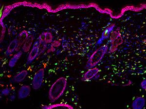 Chronic Skin Inflammation Linked to Cancer