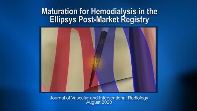 Maturation for Hemodialysis in the Ellipsys Post-Market Registry