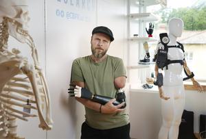 Patient wearing a prosthetic limb