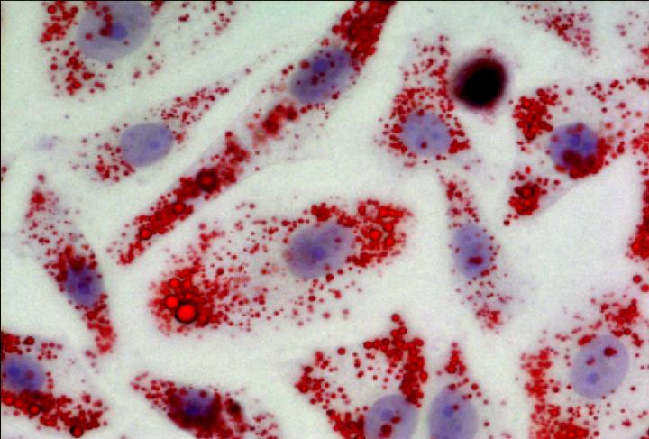 Preventing Metastasis by Stopping Cancer Cells from Making Fat (2 of 2)