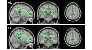 Researchers explore the neuropathological reasons that lead to the perpetration of child maltreatment by maltreating mothers