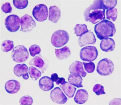 Acute Myeloid Leukemia