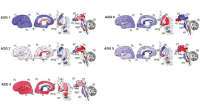 Brain diseases are better classified using analysis of gene activity