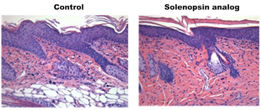 Solenopsin Analog Treatment in Psoriasis Model
