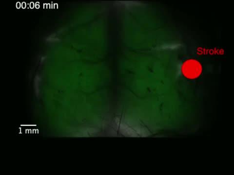 Brain 'Drowns' in Its Own Fluid after a Stroke