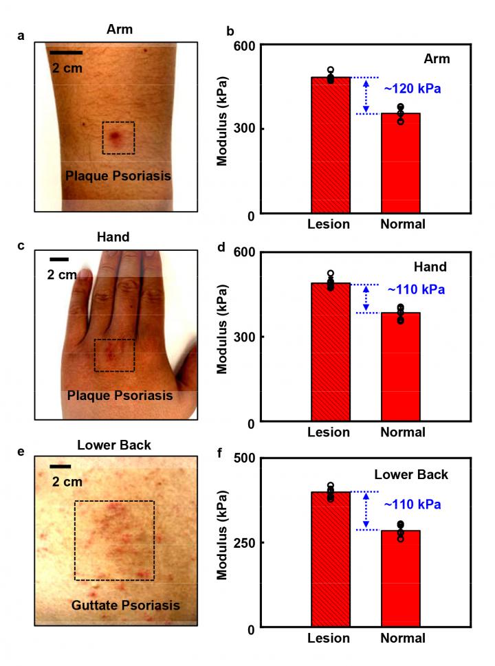 Stiffness variations between unaffected skin and lesion regions.