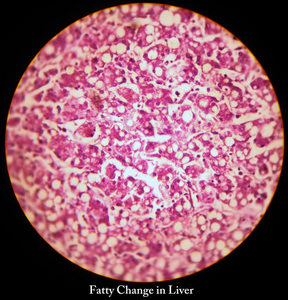 Non-alcoholic fatty liver disease, or NAFLD, affects almost a quarter of the global adult population