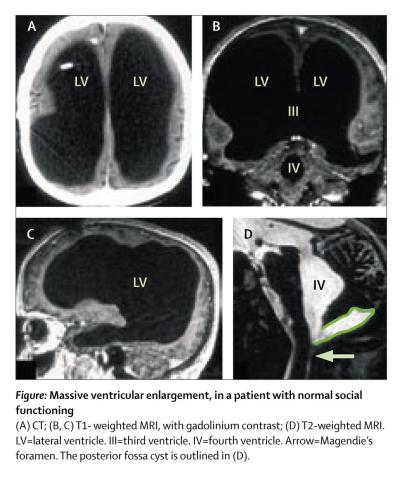 ventricles of the brain mri