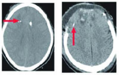 CT Scans of Traumatic Brain Iinjury