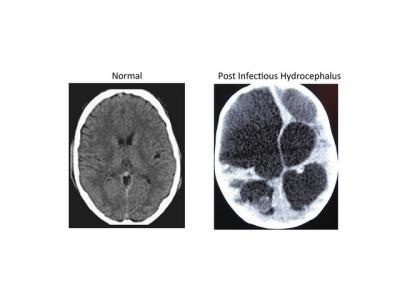 Normal and Postinfectious Hydrocephalus CT Scans