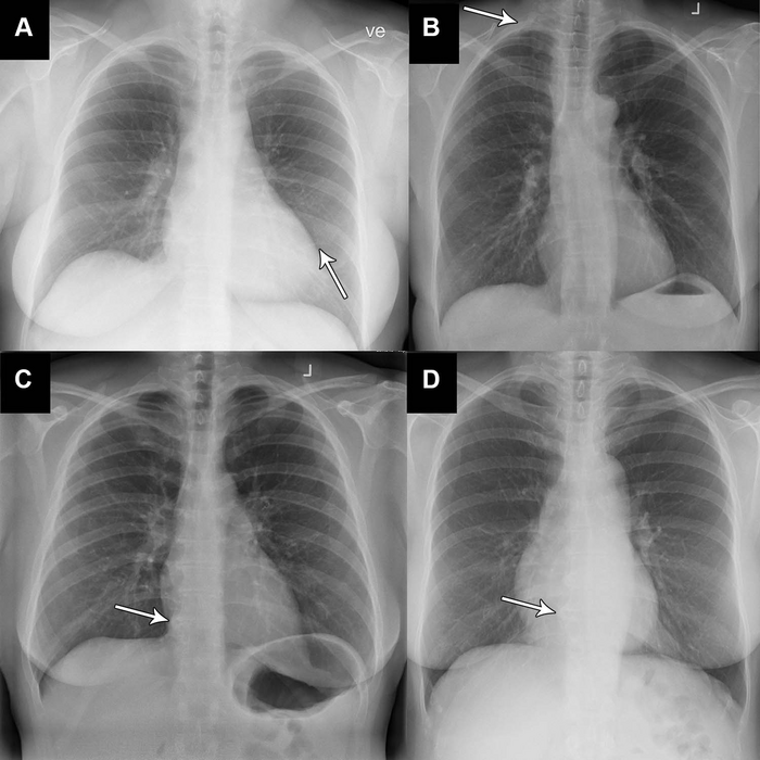 AI Accurately Identifies Normal and Abnormal Chest X-rays