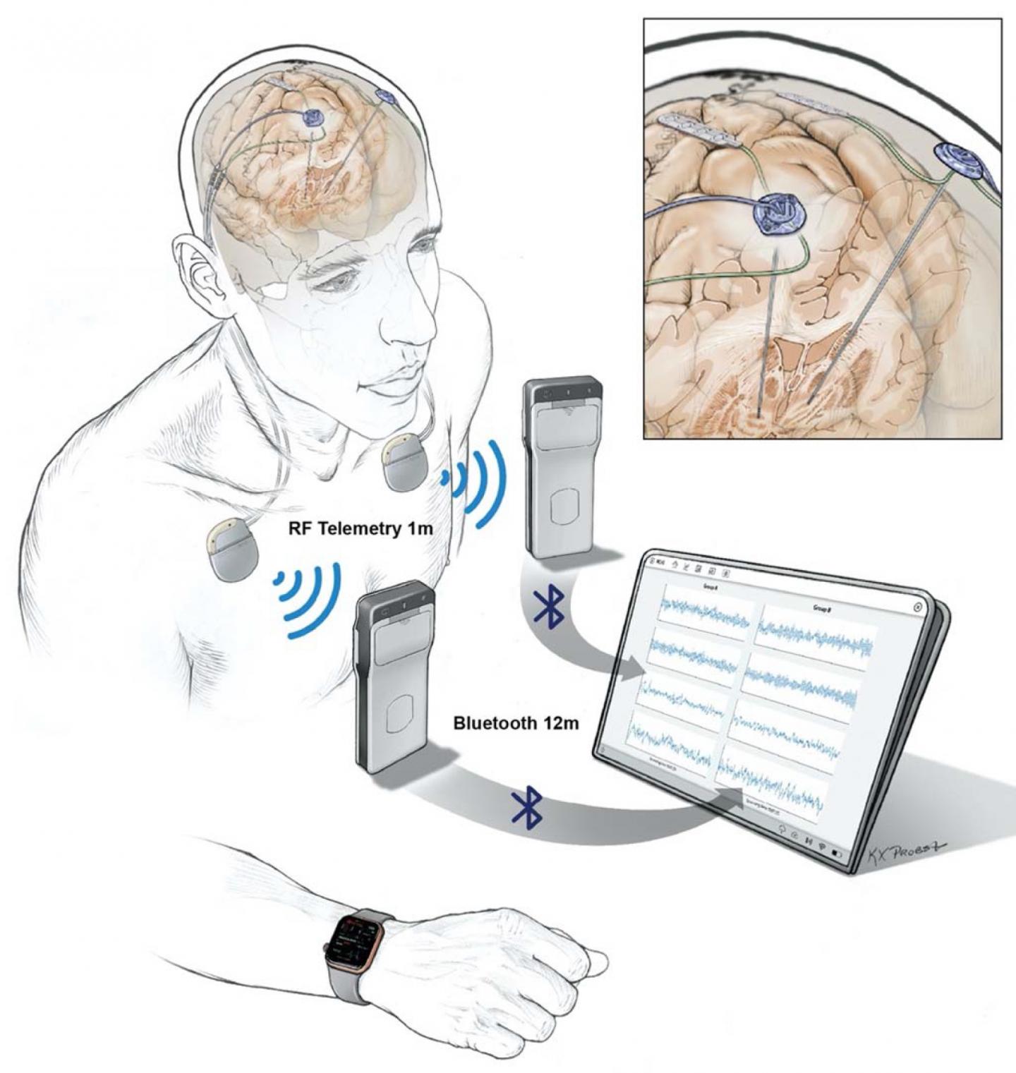 Wireless recording of brain activity