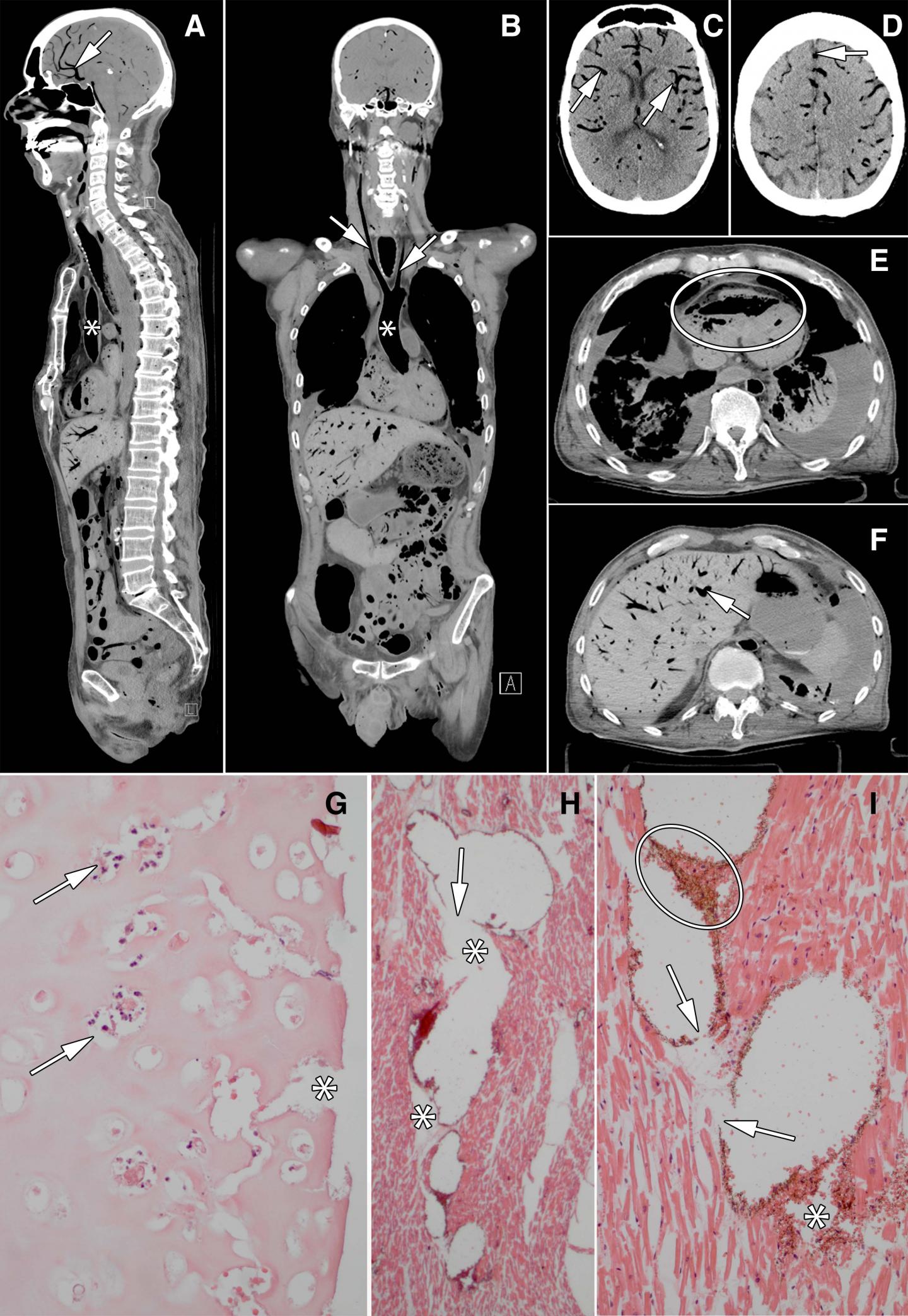 CT Autopsy Images in 60-year Old Man Who Underwent Bilateral Lung Transplant 2 Months Before Death