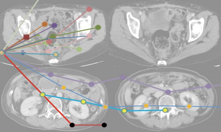 Pd-1 Antibody Beats Ovarian Cancer In Its Tracks